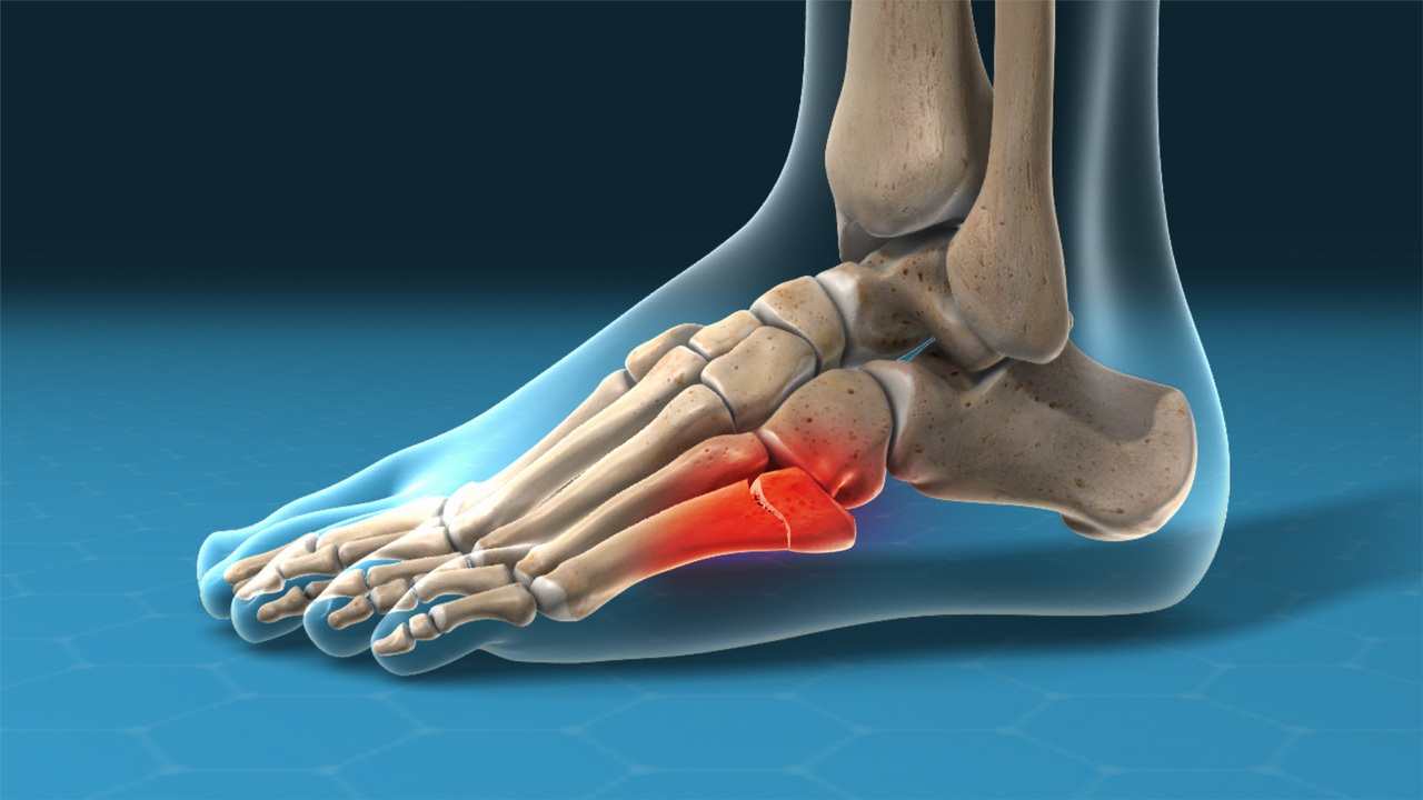 হাড় ভাঙা (Fracture)